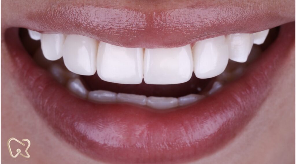 Precisión Digital: Cómo el Escaneo Intraoral 3D transformó las citas al dentista